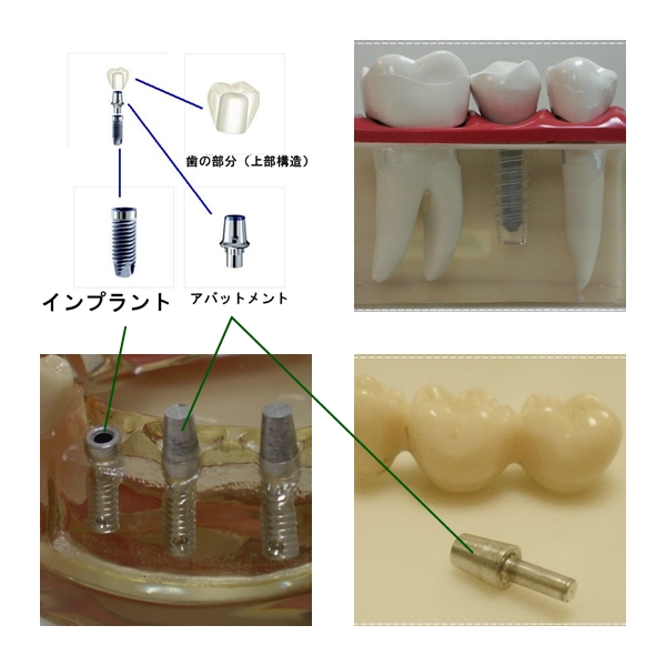 インプラントのご相談は沼津KLTメモリアル歯科インプラントセンターへ／インプラント 